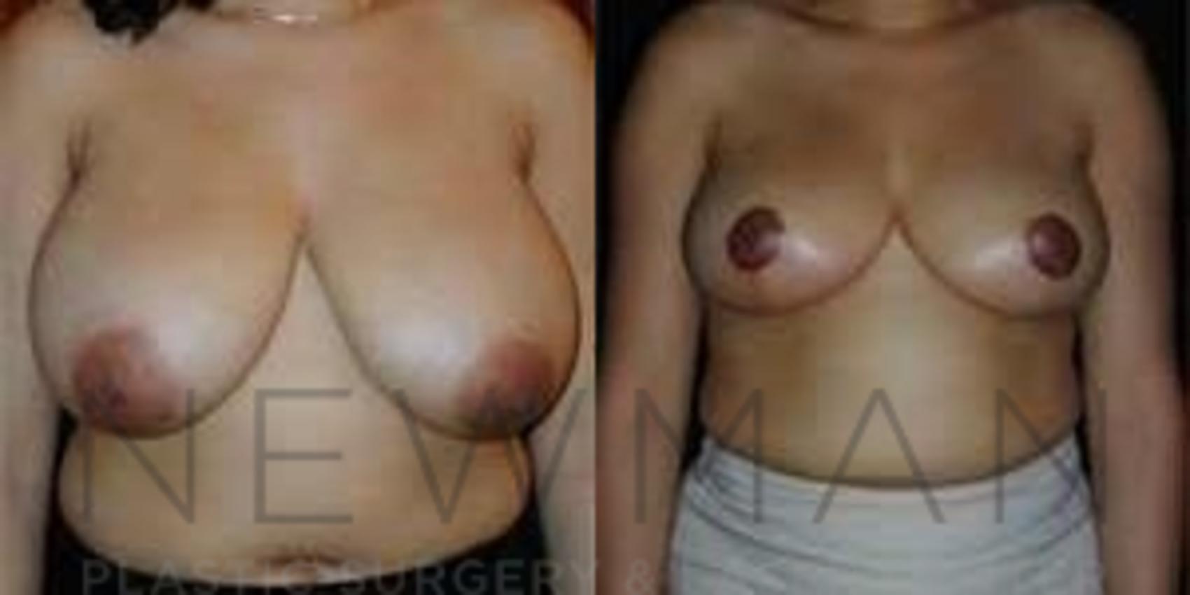 Breast Reduction before and after case 45