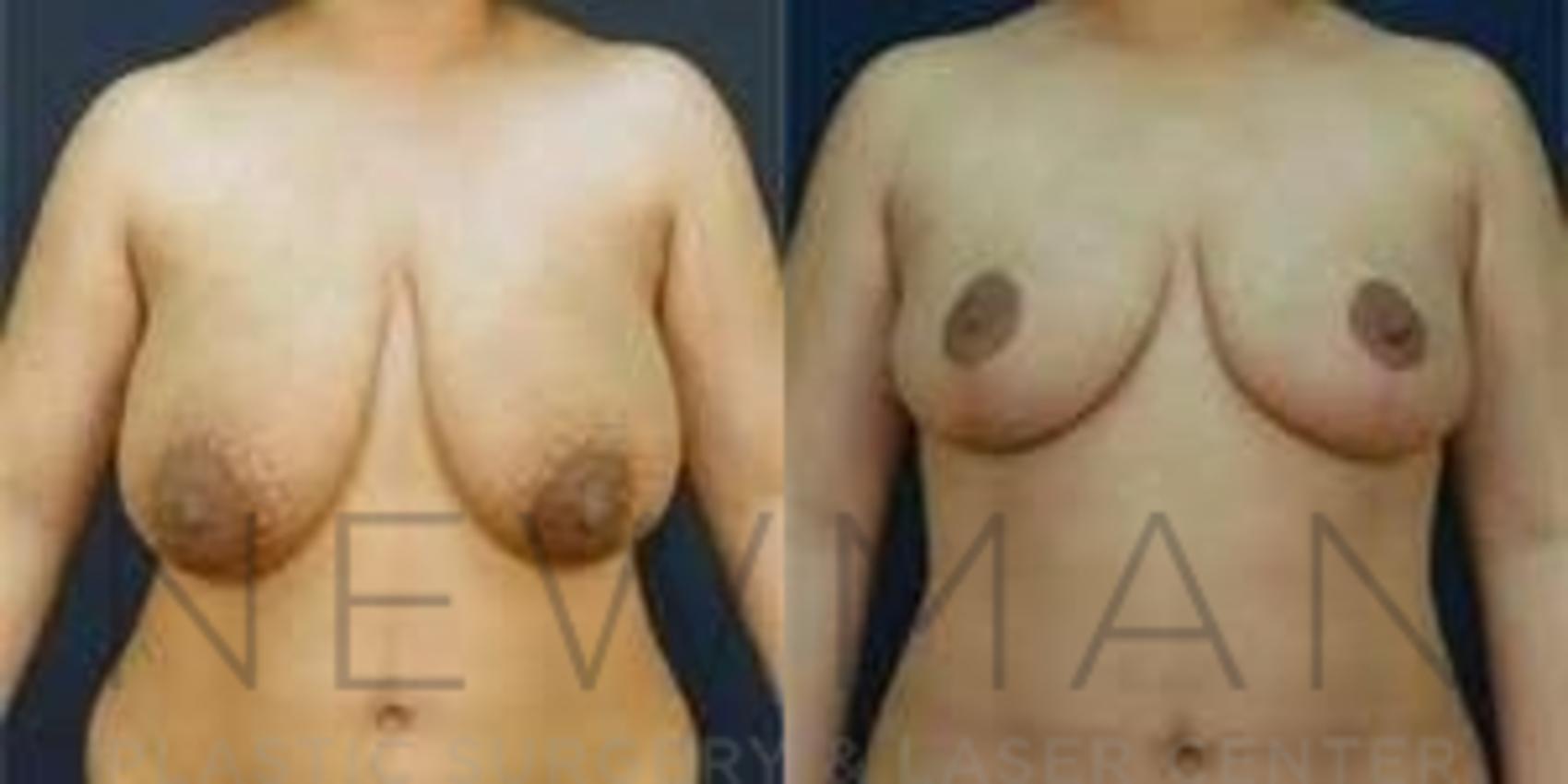 Breast Reduction before and after case 46