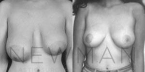 Case 47 before and after