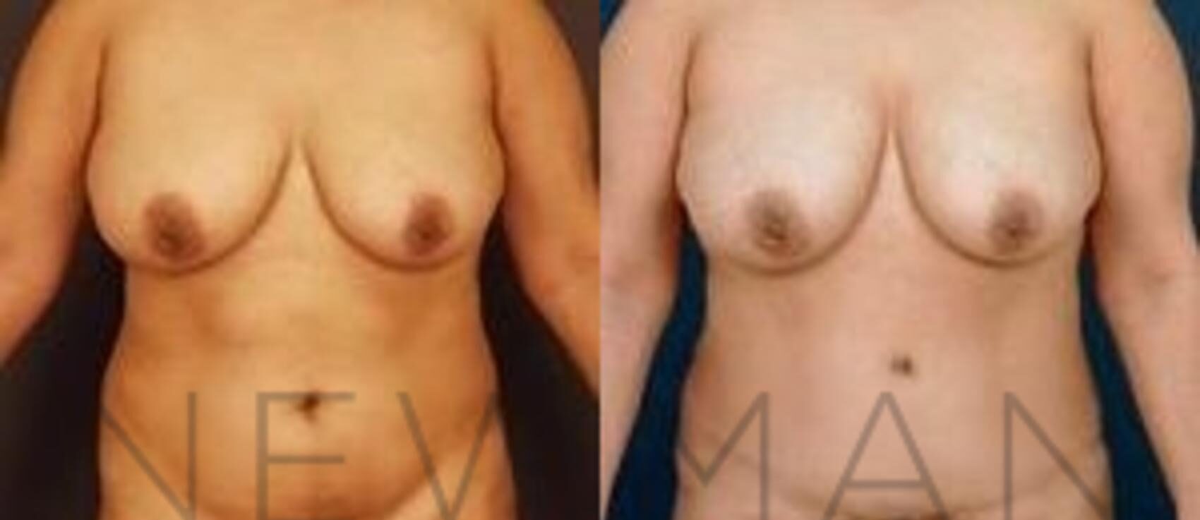 Tummy Tuck before and after case 30