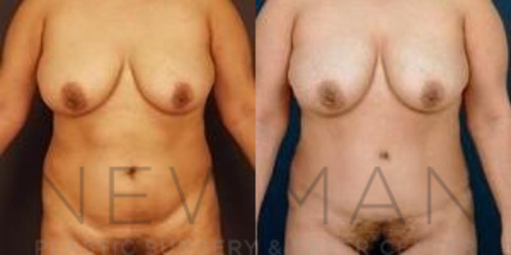 Tummy Tuck before and after case 30