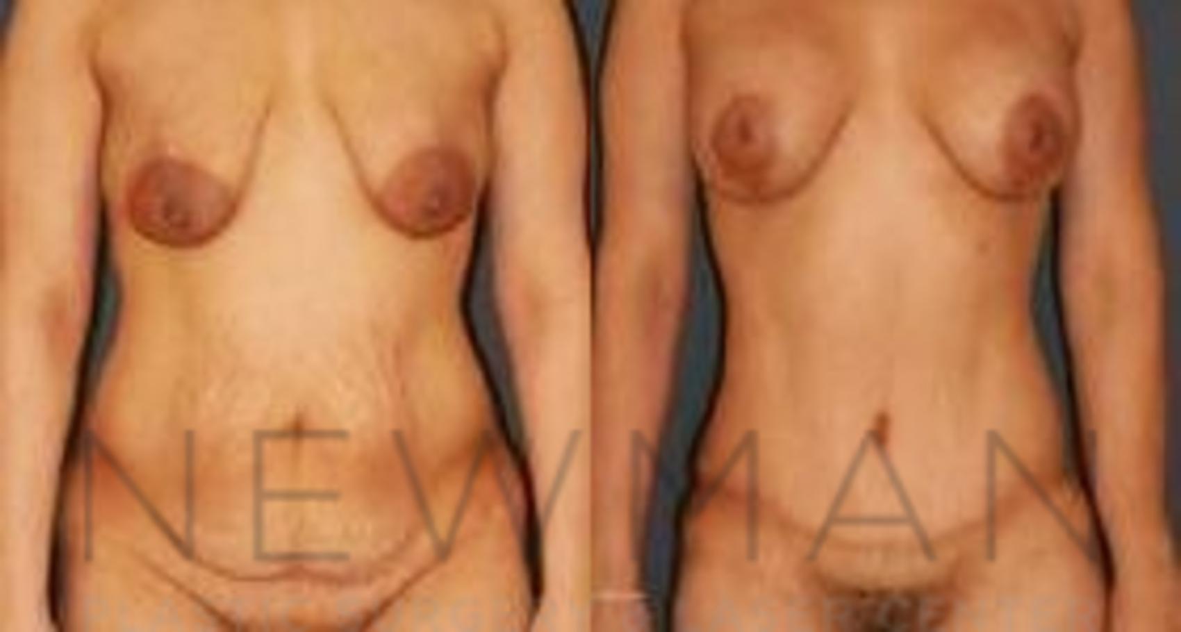 Tummy Tuck before and after case 31