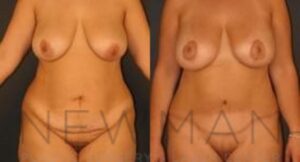 Case 33 before and after