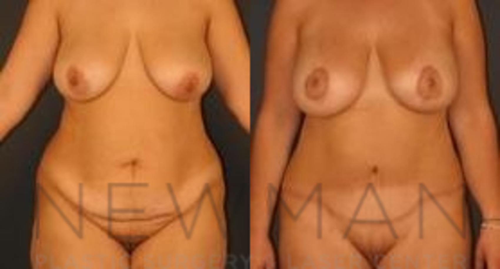 Tummy Tuck before and after case 33
