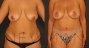 Case 34 before and after