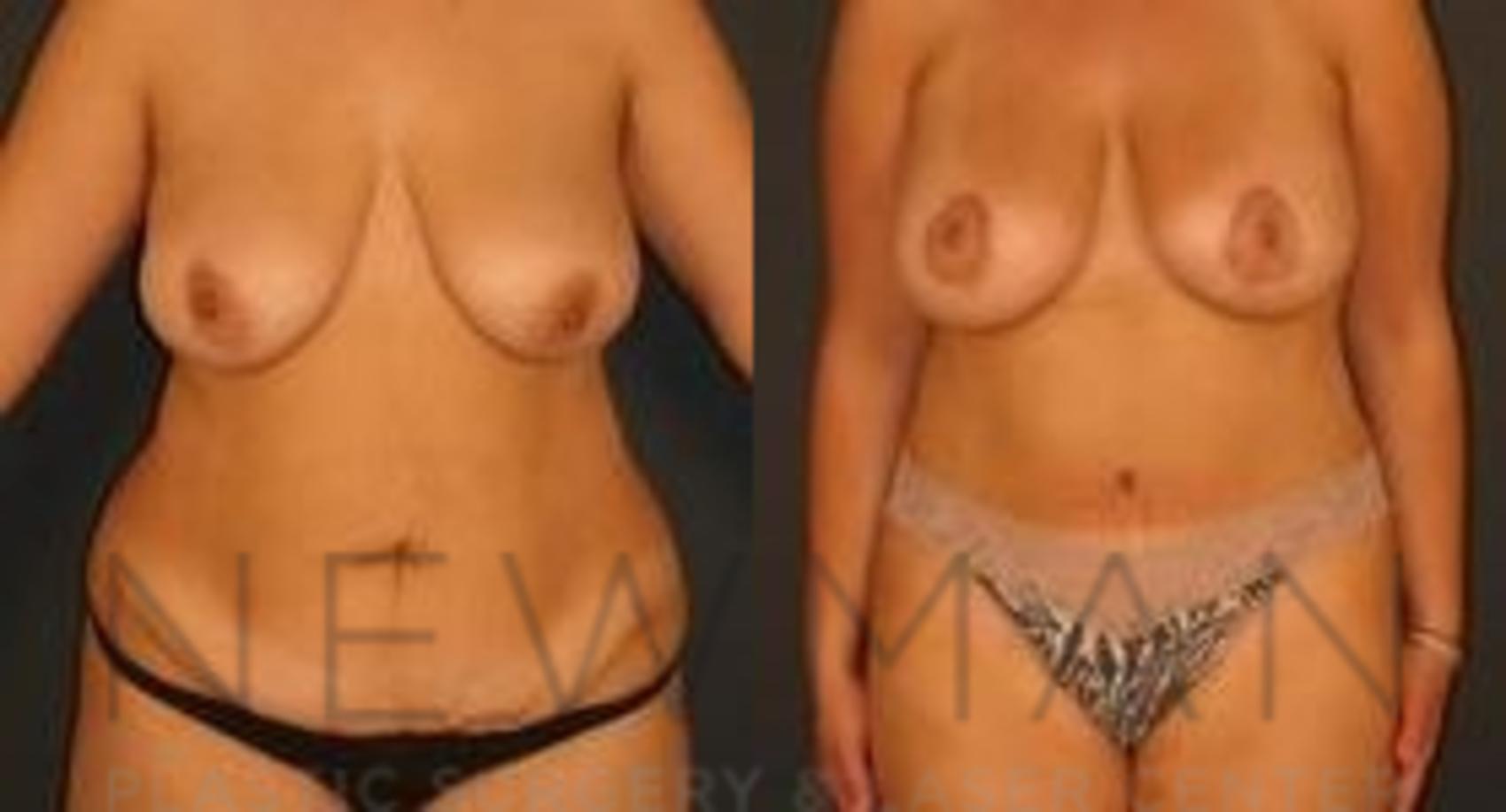 Tummy Tuck before and after case 34