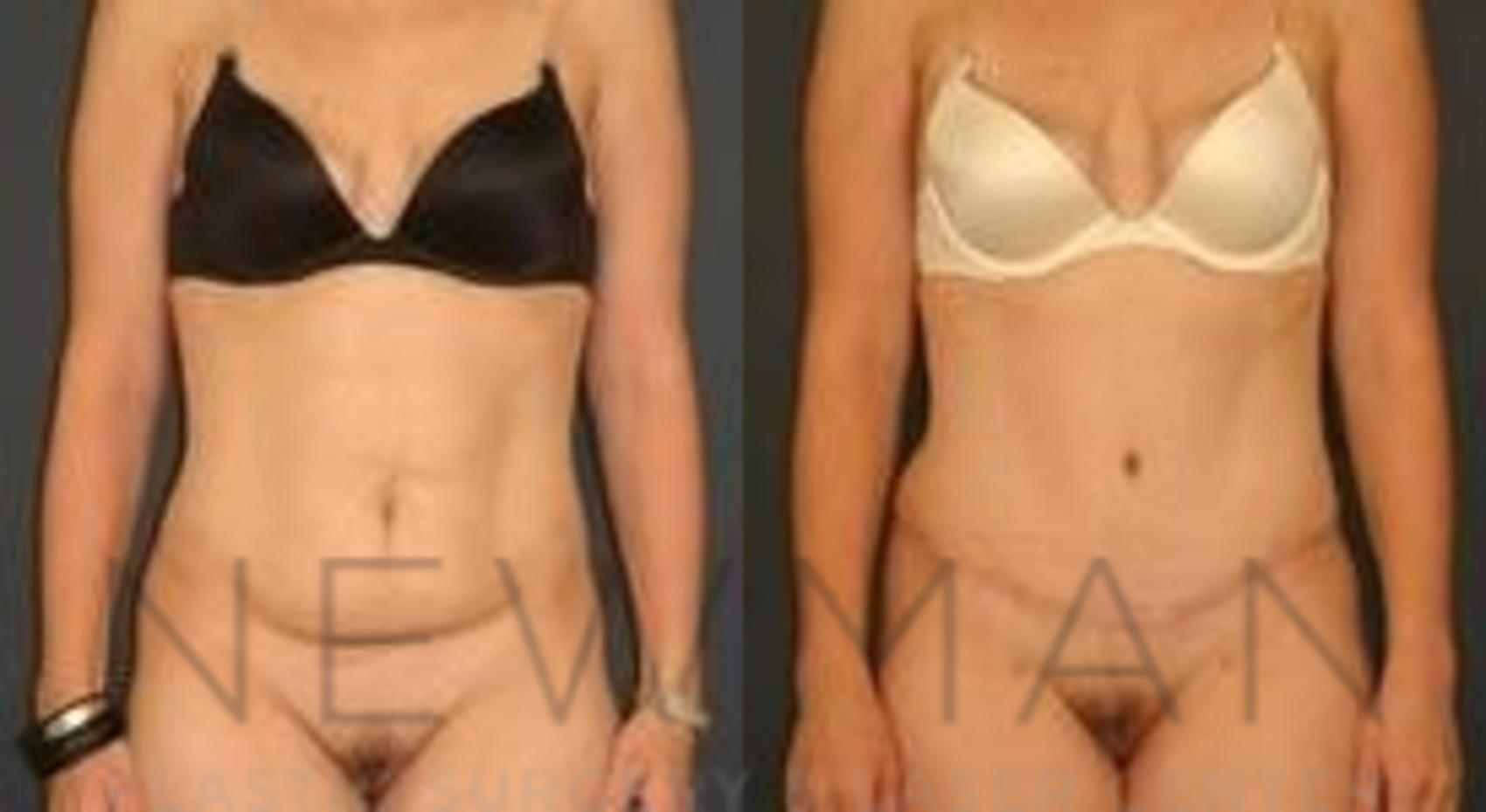Tummy Tuck before and after case 35