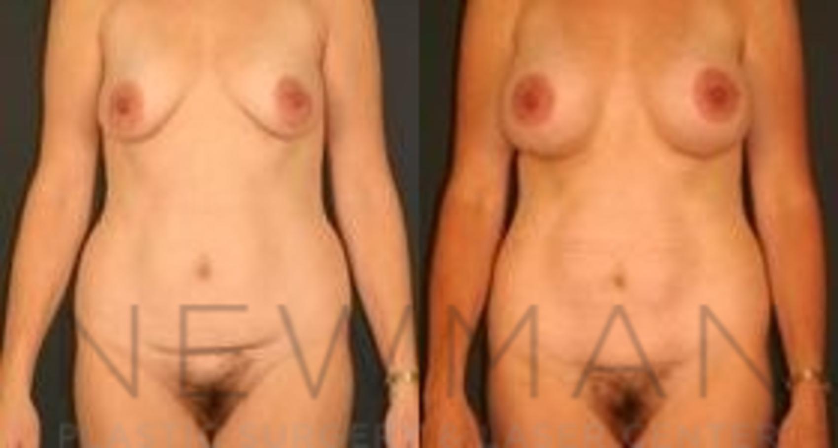 Tummy Tuck before and after case 36