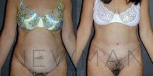 Case 37 before and after