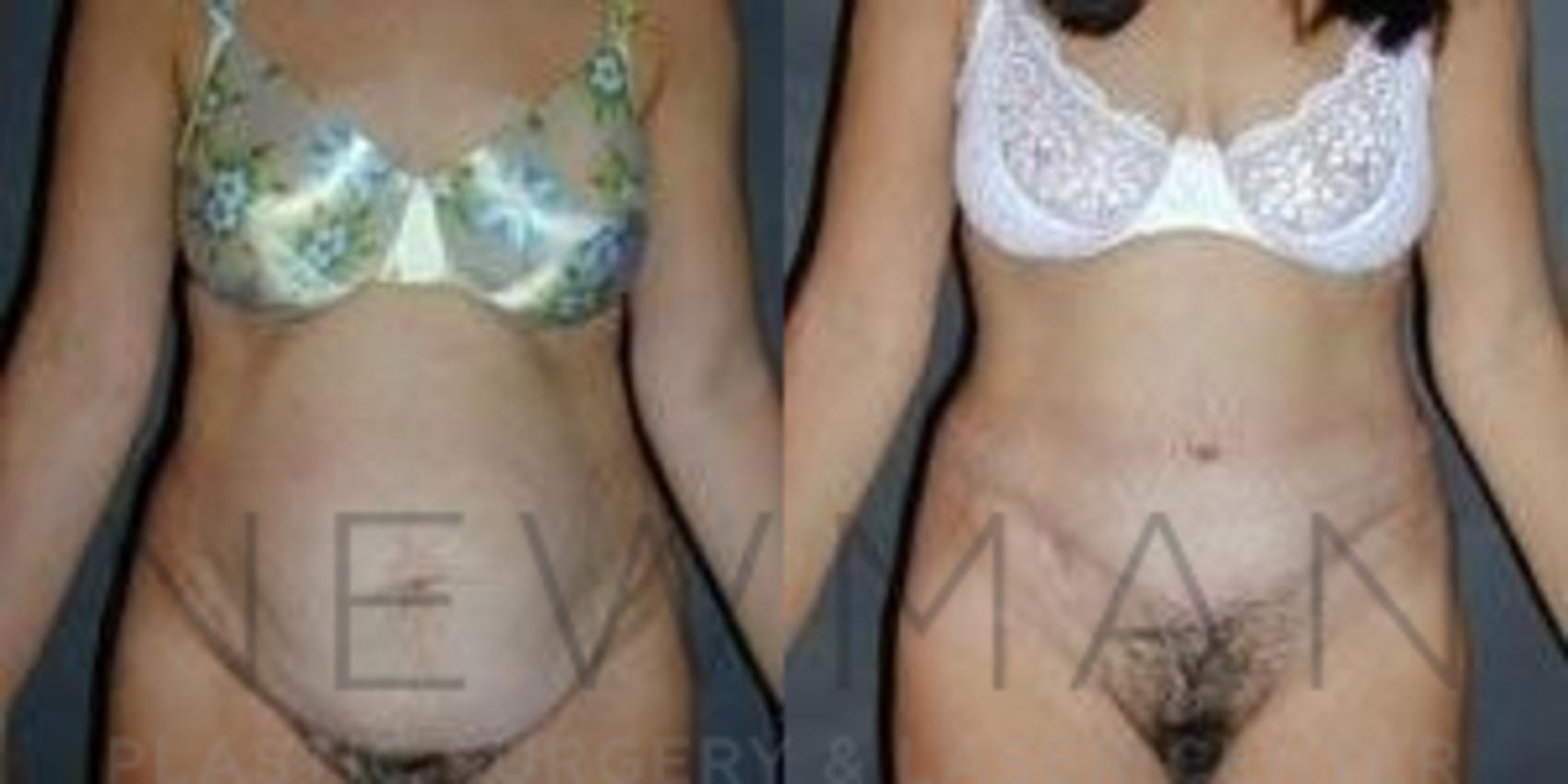 Tummy Tuck before and after case 37