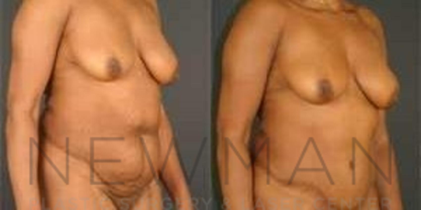 Tummy Tuck before and after case 38