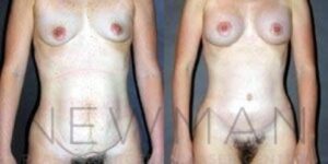 Case 39 before and after