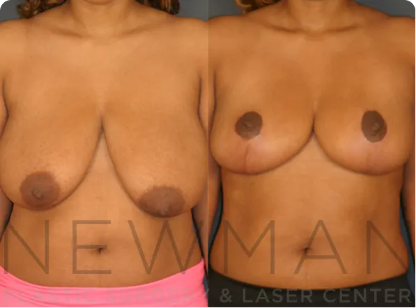 Breast Reduction before and after case 28