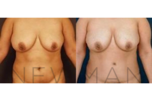 Case 30 before and after