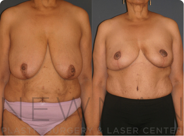 Breast Reduction before and after case 138