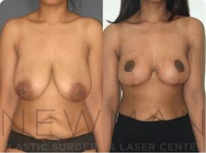 Case 139 before and after