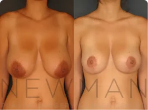 Case 140 before and after