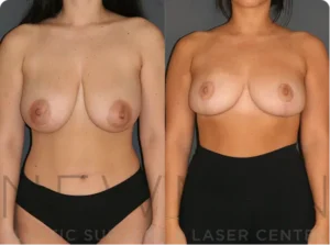 Case 146 before and after