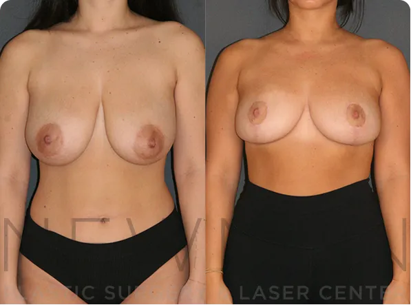 Breast Reduction before and after case 146