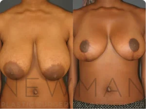 Case 141 before and after