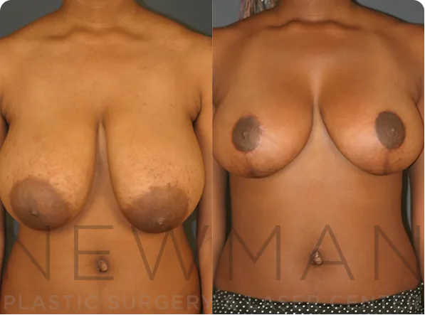 Breast Reduction before and after case 141