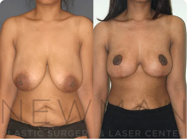 Breast Reduction before and after case 147