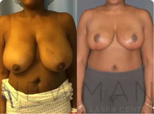 Case 148 before and after