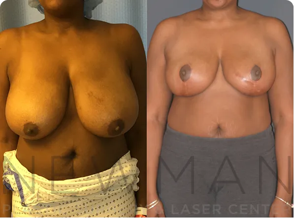 Breast Reduction before and after case 148
