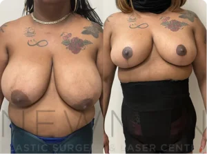 Case 149 before and after