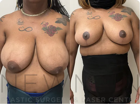 Breast Reduction before and after case 149