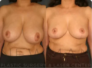 Case 142 before and after