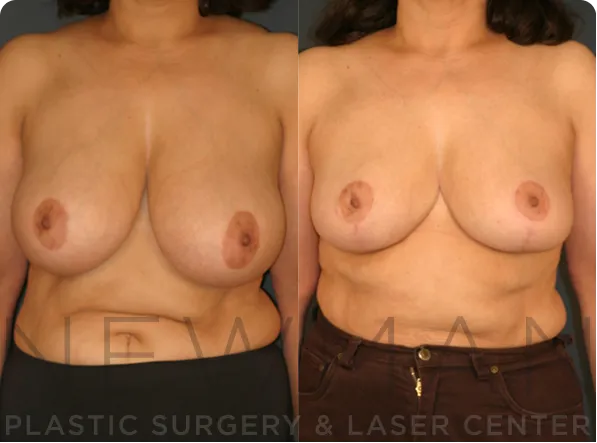 Breast Reduction before and after case 142