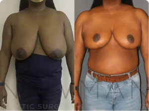 Case 150 before and after