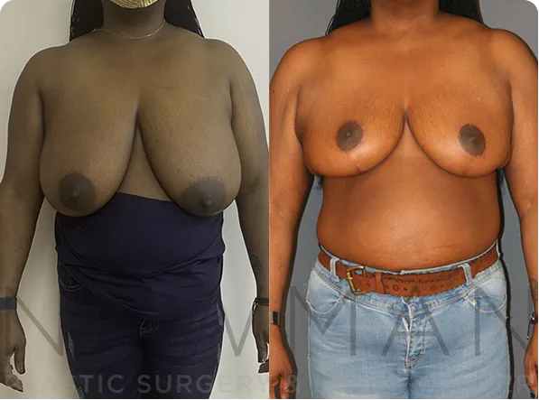 Breast Reduction before and after case 150