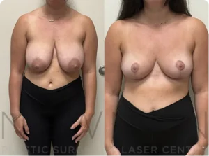 Case 151 before and after