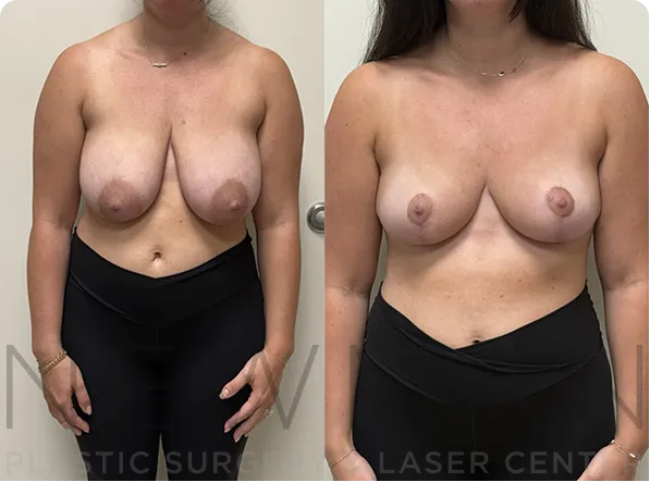 Breast Reduction before and after case 151