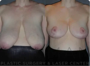 Case 144 before and after