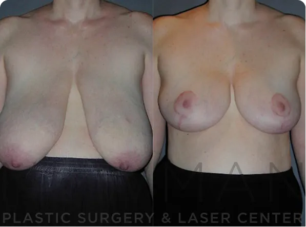 Breast Reduction before and after case 144