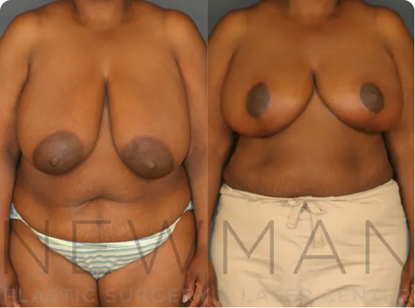 Breast Reduction before and after case 145